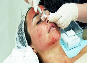 MICRONEEDLING – Dr. Shamsah Hirani